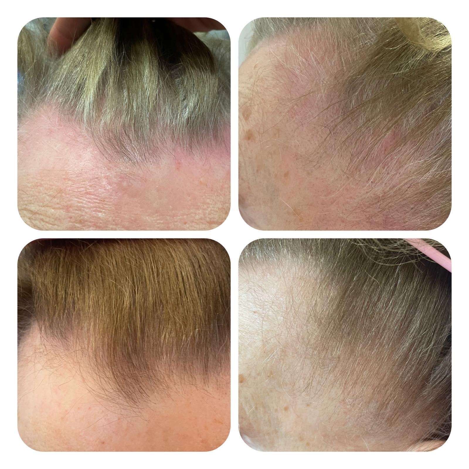laser ResurHair 1