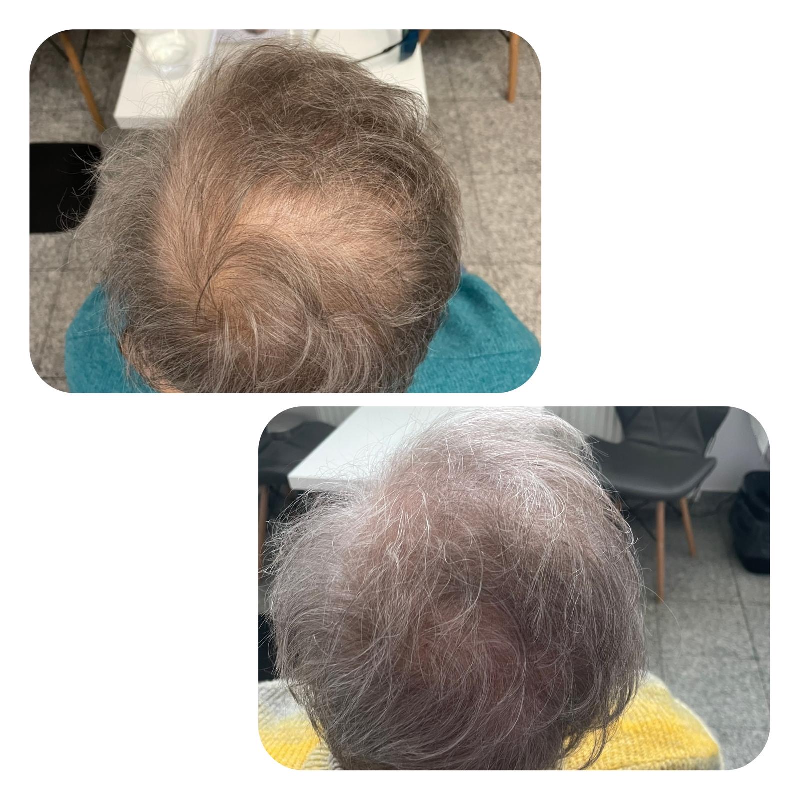 laser ResurHair 2